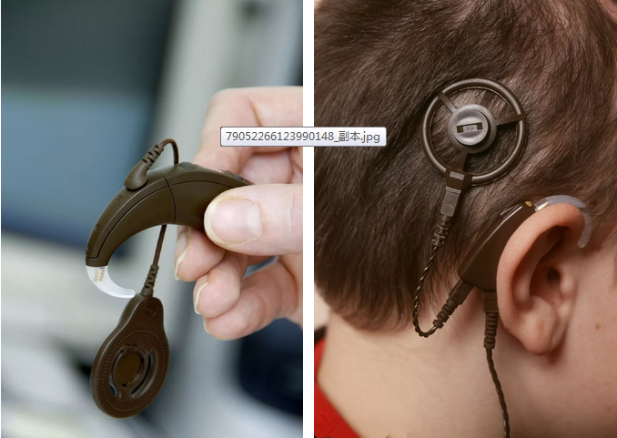 “唤醒”失聪的耳朵，仁品医院人工耳蜗植入真实案例解读！