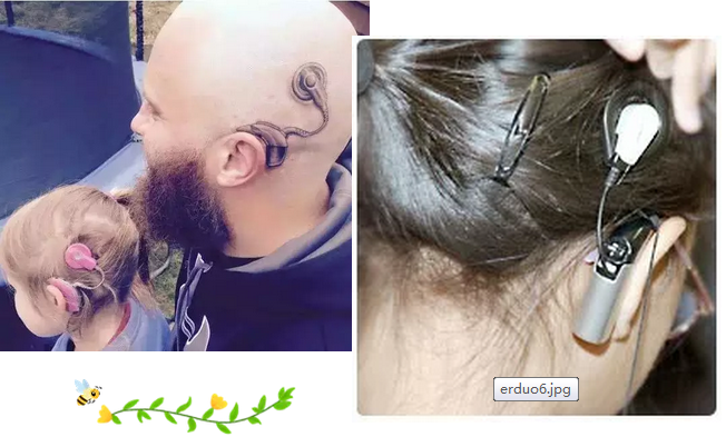 “唤醒”失聪的耳朵，仁品医院人工耳蜗植入真实案例解读！