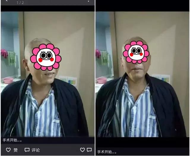  惊！耳内流“黄水”，45岁壮年男子流出中耳癌