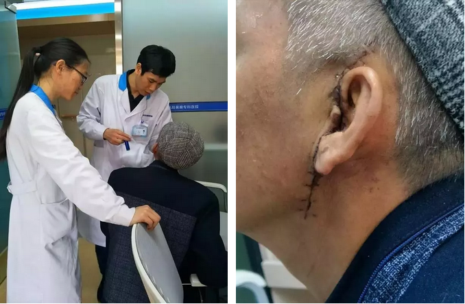  惊！耳内流“黄水”，45岁壮年男子流出中耳癌