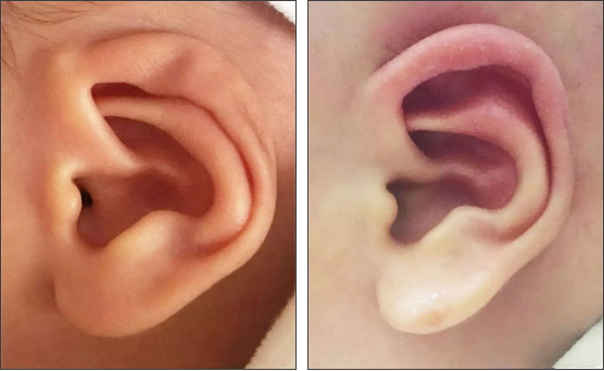 【经典案例】一个电话改变人生：新生儿耳廓畸形并非不治之症！