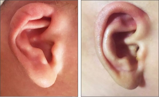 【经典案例】一个电话改变人生：新生儿耳廓畸形并非不治之症！