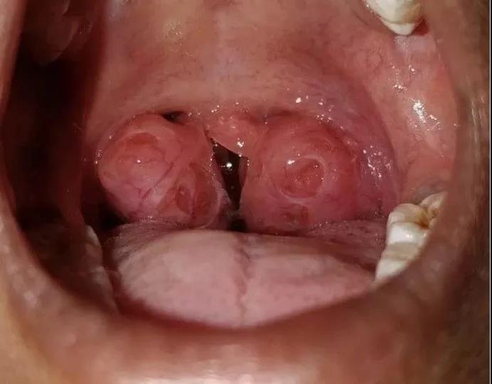 慢性扁桃体炎，到底该不该割啦？