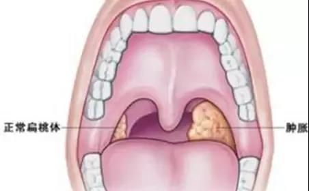 慢性扁桃体炎，到底该不该割啦？