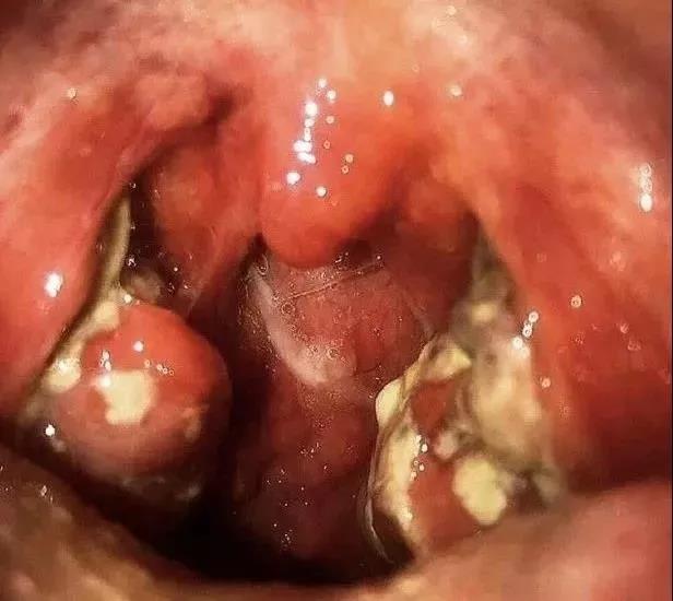 慢性扁桃体炎，到底该不该割啦？