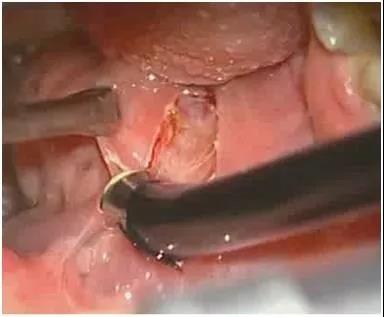 慢性扁桃体炎，到底该不该割啦？