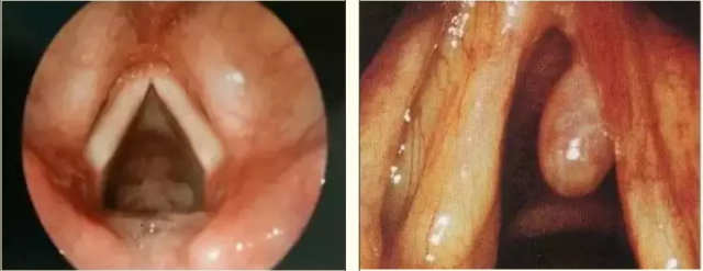 敲黑板！声音嘶哑不一定是感冒，罪魁祸首可能是它
