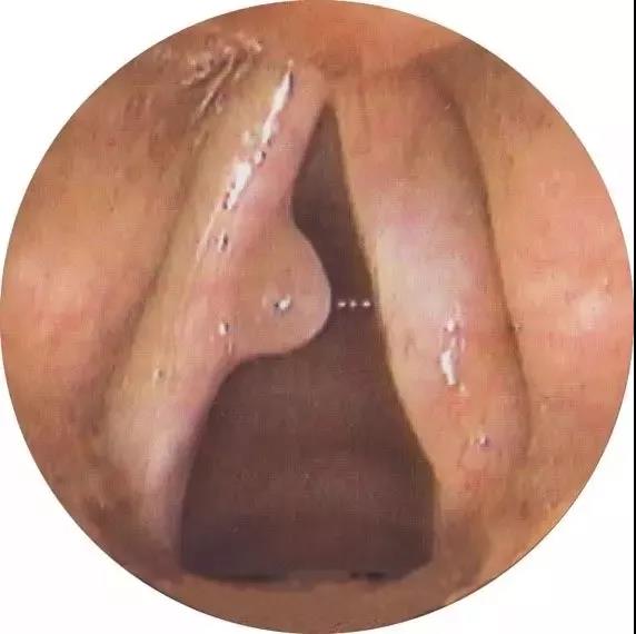 敲黑板！声音嘶哑不一定是感冒，罪魁祸首可能是它