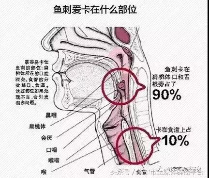 鱼刺卡喉，怎么办？