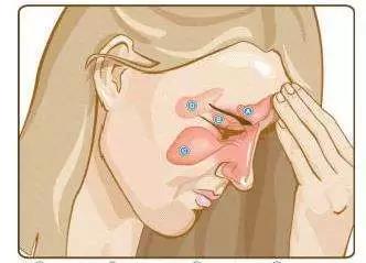 感冒or鼻窦炎？醒醒吧，别被披上伪装的鼻窦炎给弄懵啦！