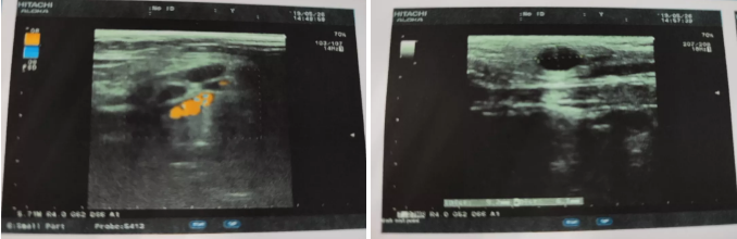 中耳炎不重视会引发癌症？还真被你说对了！