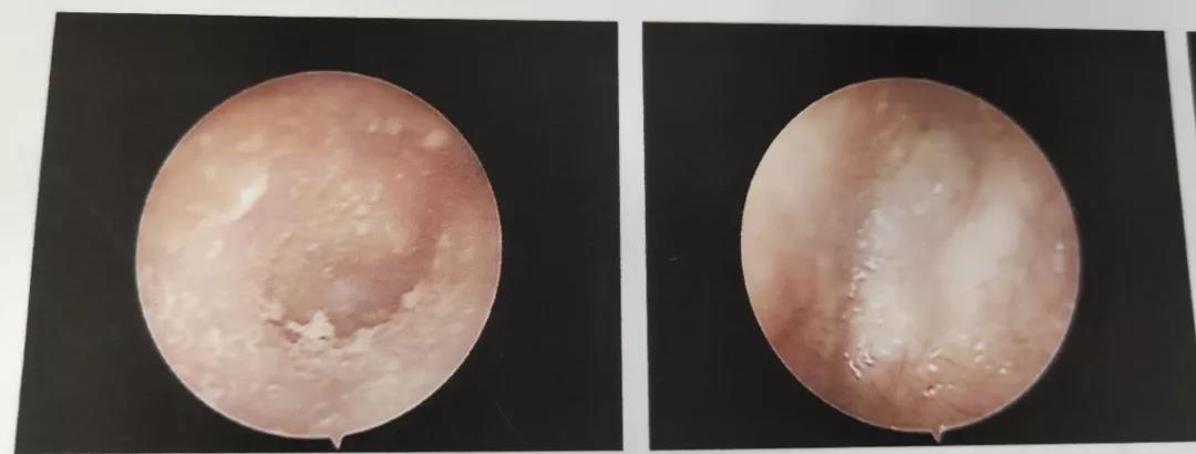 中耳炎不重视会引发癌症？还真被你说对了！