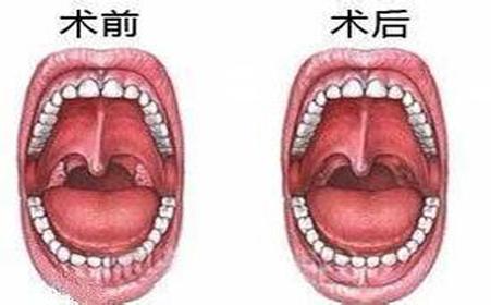 孩子感冒怎么总和扁桃体有关？扁桃体发炎还有救吗？