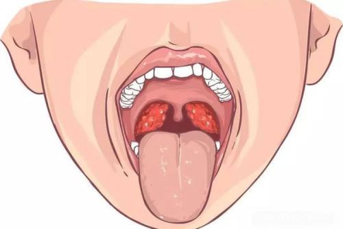 孩子感冒怎么总和扁桃体有关？扁桃体发炎还有救吗？