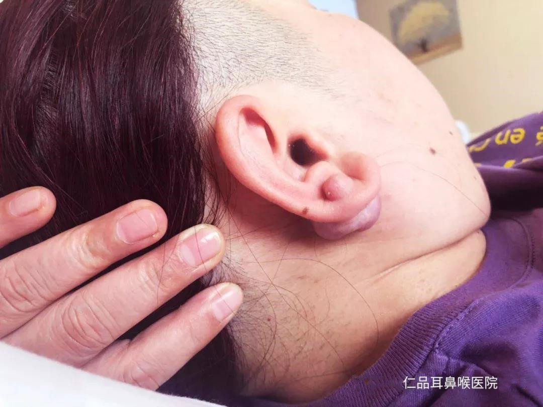 小心打耳洞打出大问题