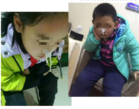 切除腺样体还能治鼻窦炎，这是什么操作？