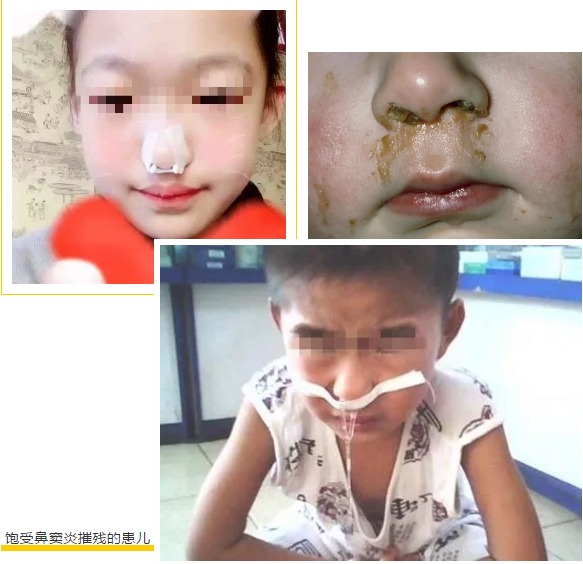 切除腺样体还能治鼻窦炎，这是什么操作？