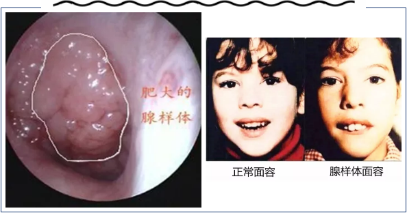 切除腺样体还能治鼻窦炎，这是什么操作？