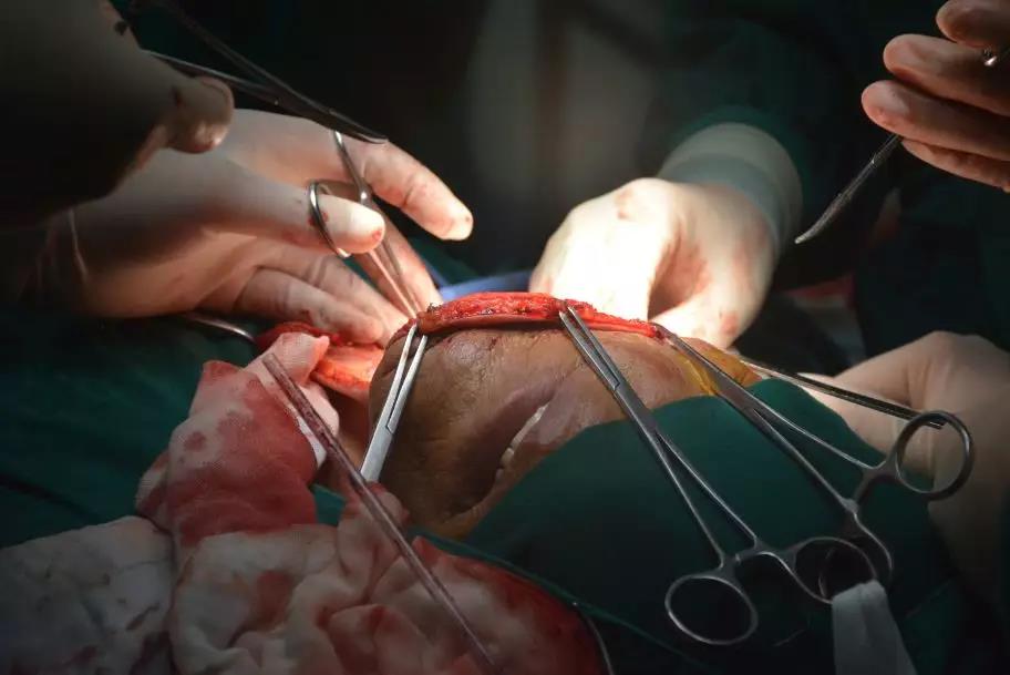 以为是“口腔溃疡”结果是口咽癌？ 这台4级高难手术敲响警钟