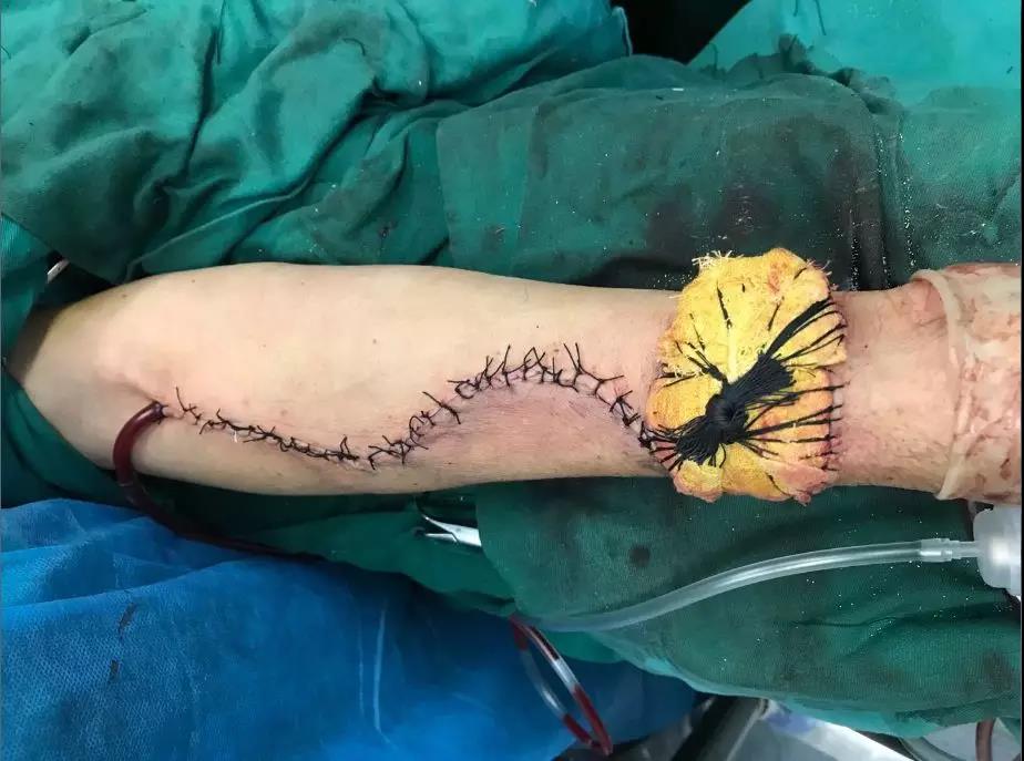 以为是“口腔溃疡”结果是口咽癌？ 这台4级高难手术敲响警钟