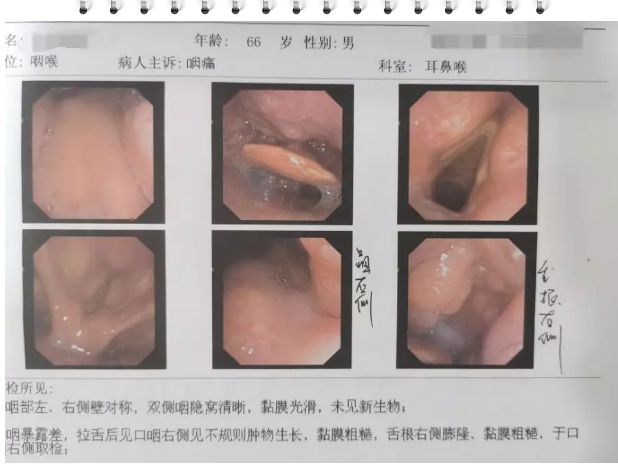 以为是“口腔溃疡”结果是口咽癌？ 这台4级高难手术敲响警钟