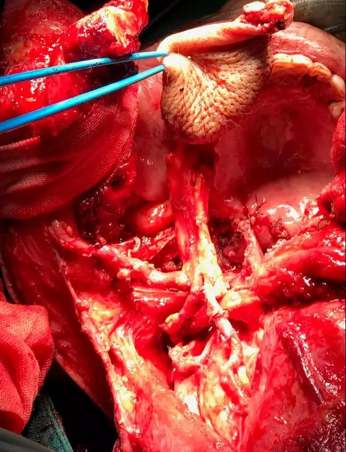 以为是“口腔溃疡”结果是口咽癌？ 这台4级高难手术敲响警钟