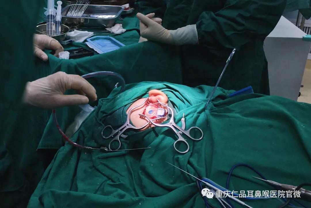成都仁品耳鼻喉医院为先天性耳聋娃娃成功植入人工耳蜗
